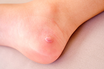 Blister on heel of foot clearance