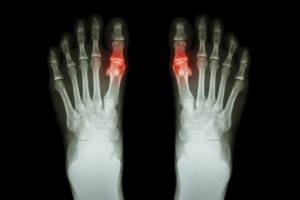 Have Painful Gout?