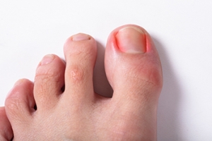 Causes and Risks of Ingrown Toenails