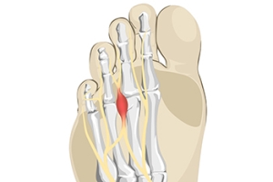 Ways to Treat Morton’s Neuroma