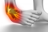 Risk Factors for Lateral Ankle Sprains