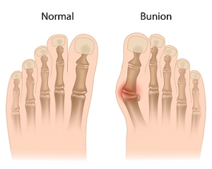 How to Treat a Bunion