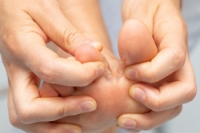 Athlete’s Foot Types and Risk Factors