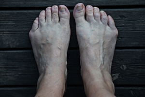 What is a Tailor’s Bunion?