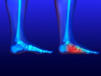 Adults May Retain Flat Feet From Birth