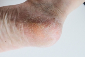 Cracked Heels and How to Prevent Them