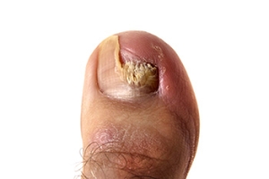 How Diabetes Affects Toenails