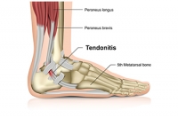 A Slight Tear or a Severe Rupture in the Achilles Tendon