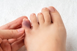 Broken Pinky Toes