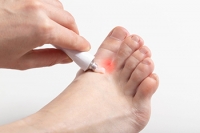 Athlete’s Foot Causes and Risk Factors