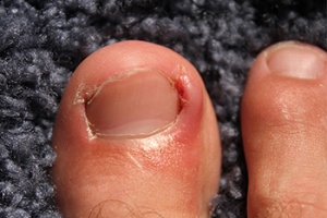 What Causes an Ingrown Toenail to Develop?